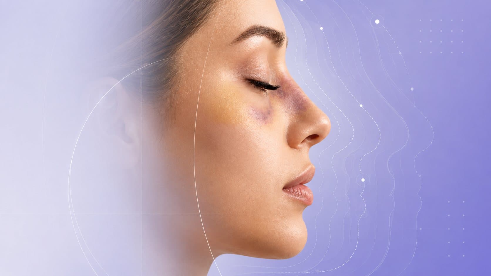 Bruising After Rhinoplasty: What the Evidence Actually Shows